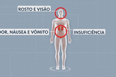 Dois novos casos de síndrome que matou em Minas são notificados em Belo Horizonte