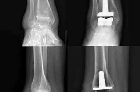 Prótese de tornozelo é alternativa para não perder o movimento da articulação